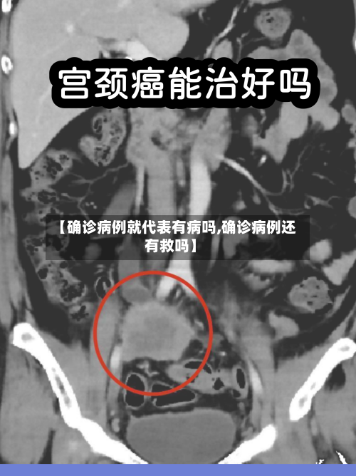【确诊病例就代表有病吗,确诊病例还有救吗】-第2张图片