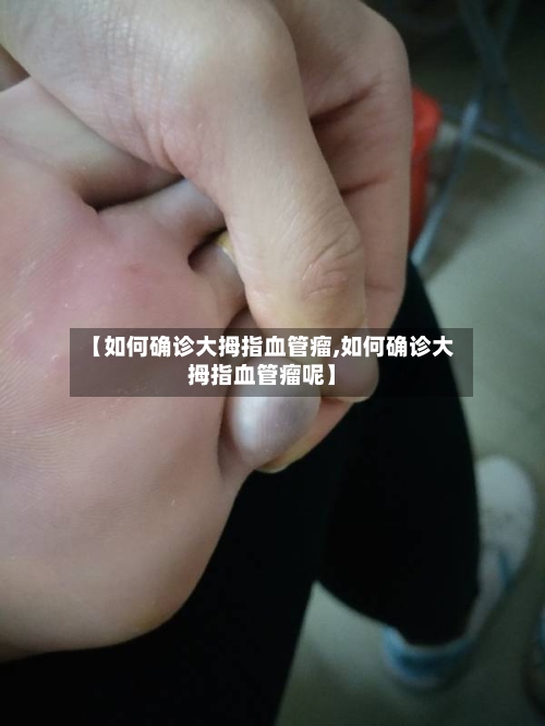【如何确诊大拇指血管瘤,如何确诊大拇指血管瘤呢】