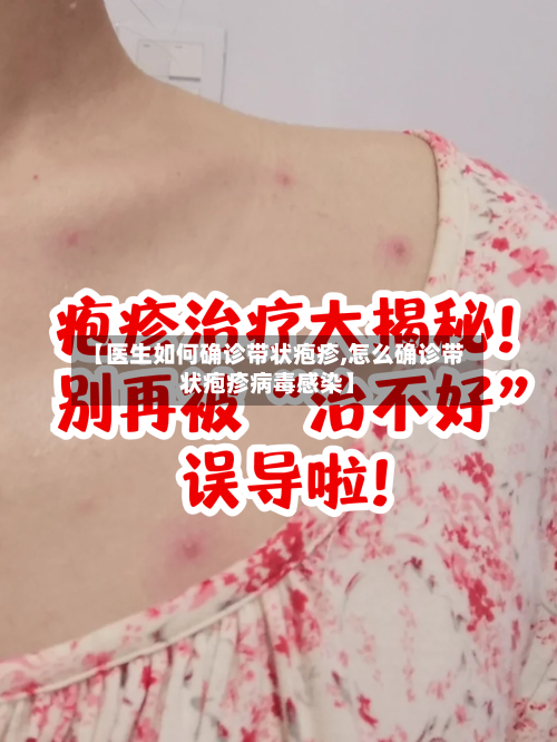 【医生如何确诊带状疱疹,怎么确诊带状疱疹病毒感染】-第2张图片