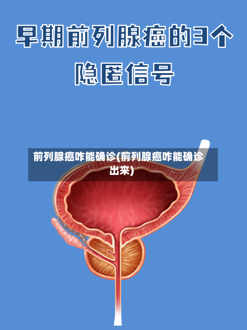 前列腺癌咋能确诊(前列腺癌咋能确诊出来)-第2张图片