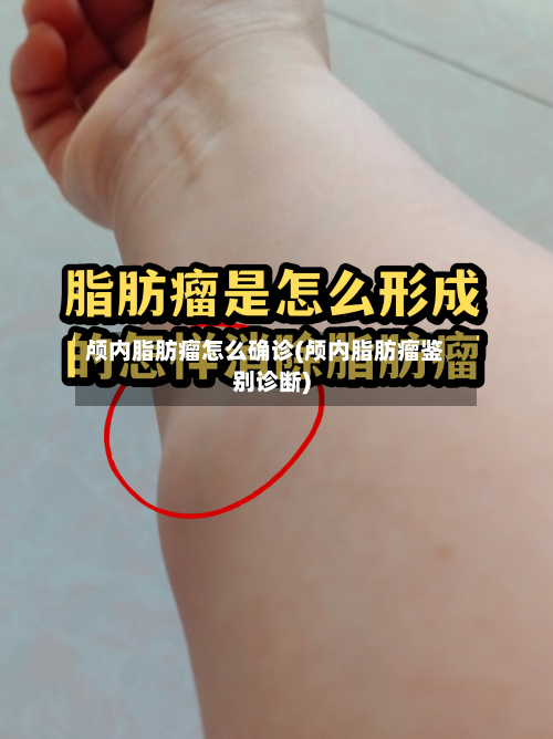 颅内脂肪瘤怎么确诊(颅内脂肪瘤鉴别诊断)
